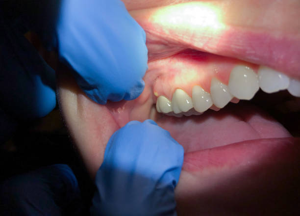 Best Emergency Wisdom Teeth Removal in Hurt, VA