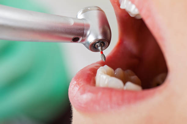 Best Emergency Dental Care for Broken or Chipped Teeth in Hurt, VA